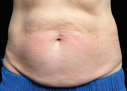 Emsculpt Neo before — Abdomen — Female, 6 months after final treatment