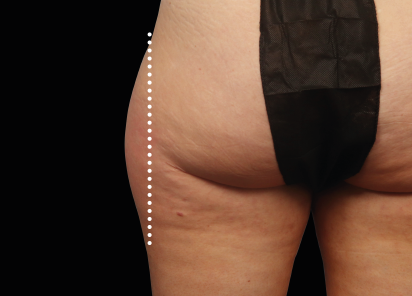Emsculpt Neo before — Outer Thighs — Female, immediately after final treatment