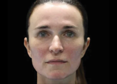 Emface after — Full Face — after 4th treatment