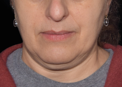 Emface before — Jawline — 4 treatments