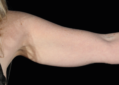 Emsculpt Neo before — Arms — Female, immediately after final treatment