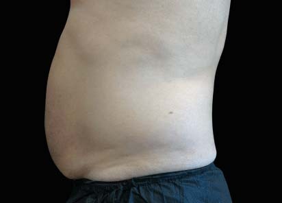 Emsculpt Neo after — Abdomen — Male, 1 month after final treatment