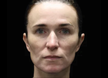 Emface before — Full Face — after 4th treatment
