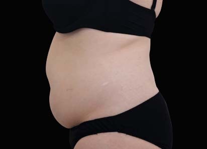 Emsculpt Neo before — Abdomen — Female, 1 month after final treatment