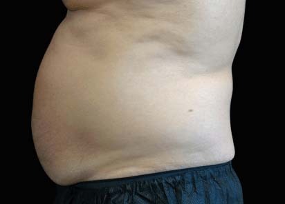 Emsculpt Neo before — Abdomen — Male, 1 month after final treatment