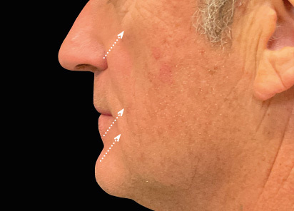 Emface after — Full Face — 3 months after 4th treatment