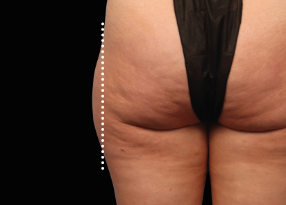 Emsculpt Neo after — Outer Thighs — Female, immediately after final treatment
