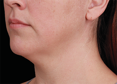 Emface before — Submentum — Female, after 4th treatment