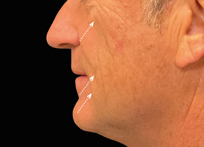 Emface before — Full Face — 3 months after 4th treatment