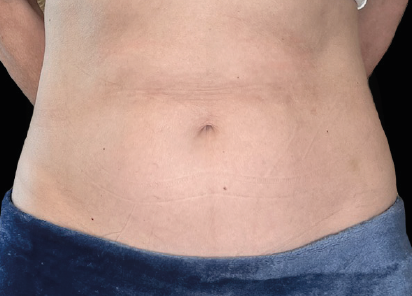 Emsculpt Neo after — Abdomen — Female, 6 months after final treatment