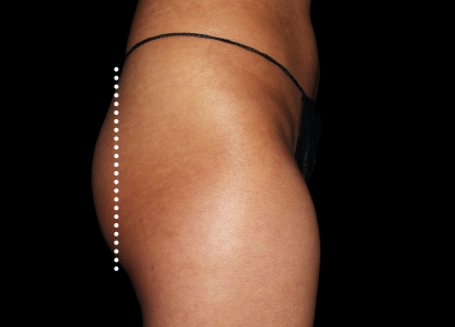 Emsculpt Neo before — Buttocks — Female, 3 months after final treatment