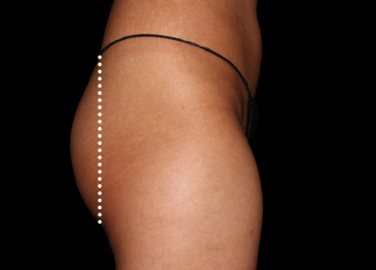 Emsculpt Neo after — Buttocks — Female, 3 months after final treatment