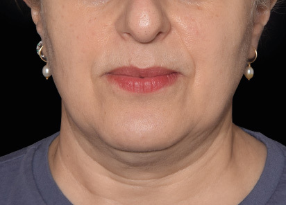 Emface after — Jawline — 4 treatments