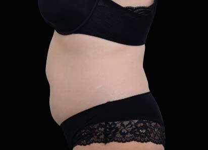 Emsculpt Neo after — Abdomen — Female, 1 month after final treatment