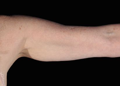Emsculpt Neo after — Arms — Female, immediately after final treatment