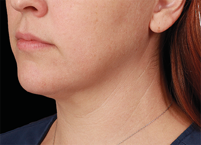 Emface after — Submentum — Female, after 4th treatment